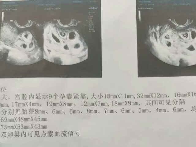 台灣新聞通訊社-懷九胞胎大陸江西女子進行第二次減胎手術 最終留下兩胎