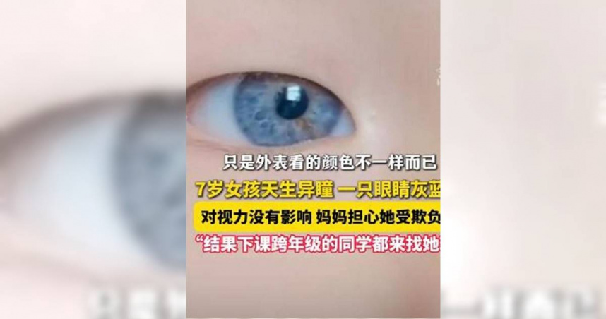 台灣新聞通訊社-7歲女孩「天生異瞳」一眼黑一眼灰藍　醫生揭原因：1情況快就醫