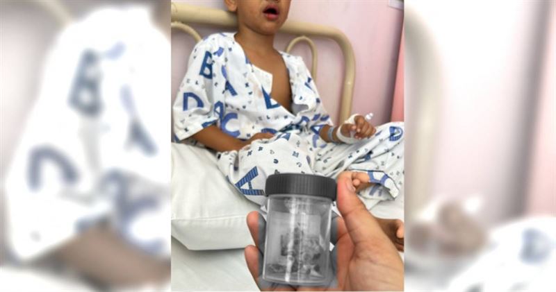 台灣新聞通訊社-男童從小1壞習慣不改害嚴重蛀牙 一次被拔12顆牙齒