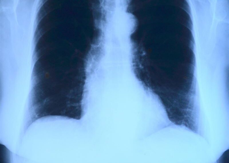 台灣新聞通訊社-連咳5天當普通感冒 他照X光竟「左肺一片白」!下場慘了