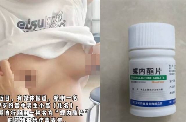 台灣新聞通訊社-痘痘治好胸部升級！17歲少年連吞8瓶藥　險釀不可逆「男性女乳症」
