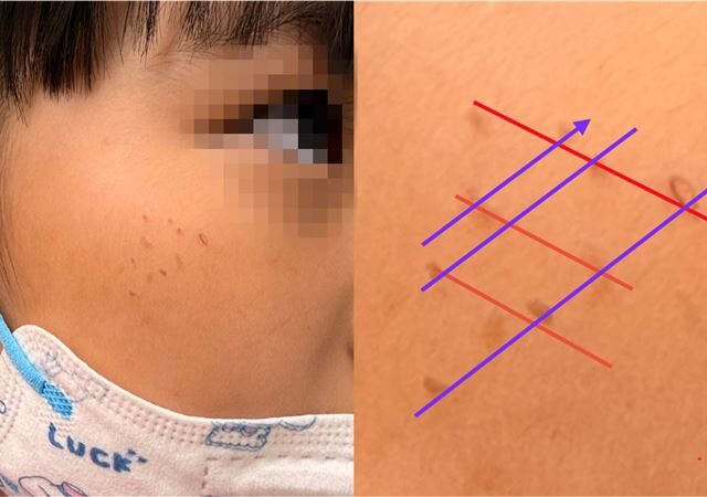 台灣新聞通訊社-不是蟲咬的！女童臉上驚見「一整排紅疹」　醫曝1物惹的禍