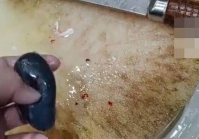 台灣新聞通訊社-女子聽信治頭痛偏方「生吞魚膽」慘送ICU　醫揭真相：比砒霜還毒