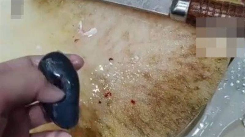 台灣新聞通訊社-女子聽信治頭痛偏方「生吞魚膽」慘送ICU 醫揭真相:比砒霜還毒