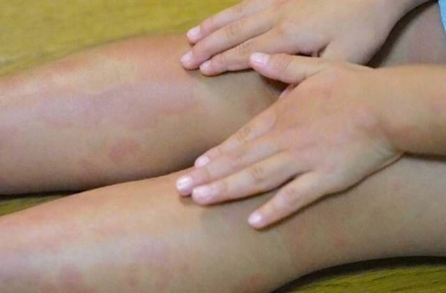 台灣新聞通訊社-全家衣物混洗「女童長紅疹」元凶是父親香港腳　醫：嚴重恐毀容