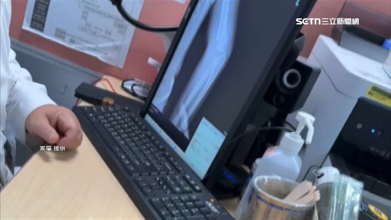 台灣新聞通訊社-獨家／嚇！兒玩夜市充氣床摔斷手開刀　母掉淚自責