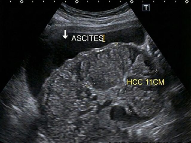 台灣新聞通訊社-40歲男肚子大以為脹氣！超音波一掃全場安靜「11公分巨大肝腫瘤」