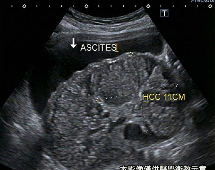 台灣新聞通訊社-40歲男肚子大以為脹氣！超音波一掃全場安靜「11公分巨大肝腫瘤」