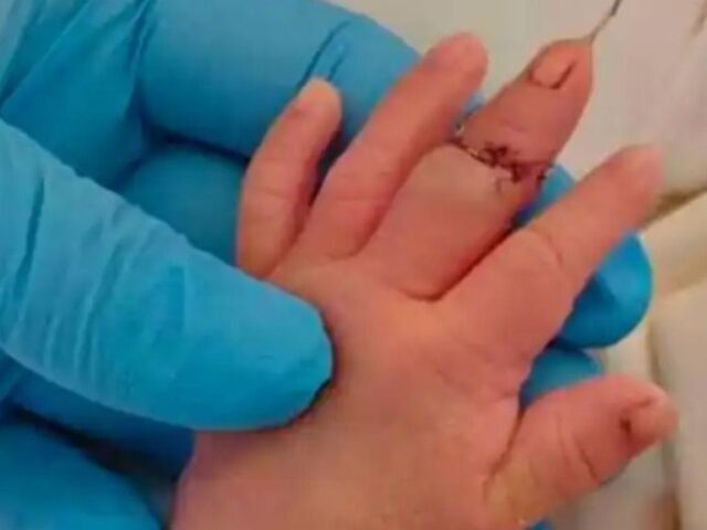 台灣新聞通訊社-離譜／江蘇助產士剪臍帶剪斷嬰手指 辯「新生兒亂動」