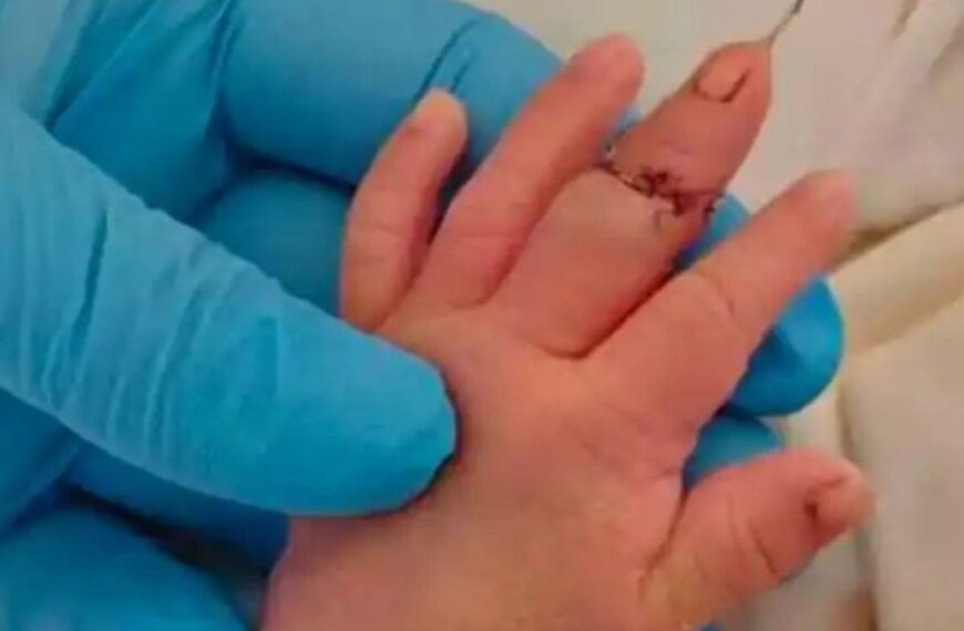 台灣新聞通訊社-離譜／江蘇助產士剪臍帶剪斷嬰手指 辯「新生兒亂動」