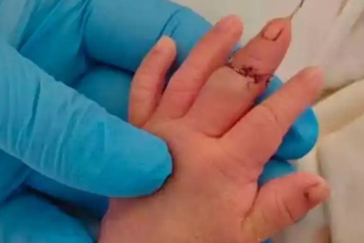 台灣新聞通訊社-離譜／江蘇助產士剪臍帶剪斷嬰手指 辯「新生兒亂動」