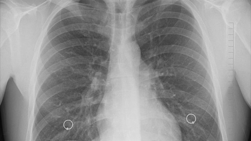 台灣新聞通訊社-台南老菸槍「肺活量剩29%」僅走百步　奇美醫院靠1招幫回血