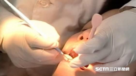 台灣新聞通訊社-中低收老人「假牙補助」沒了？衛福部曝原因：回歸地方辦理