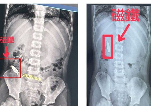台灣新聞通訊社-小一童遭逼吞磁鐵！補習班竟不看監視器　家長淚訴孩子半夜驚醒問這句