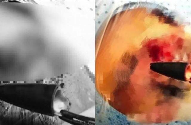 台灣新聞通訊社-46歲男眼痛「開刀取出2.5cm筆頭」　醫一問：卡眼眶27年