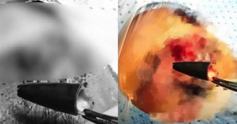 台灣新聞通訊社-46歲男眼痛「開刀取出2.5cm筆頭」　醫一問：卡眼眶27年