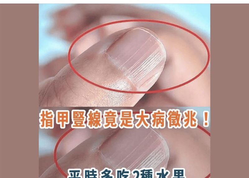 台灣新聞通訊社-網傳「指甲豎線」是大病癥兆？　專家：誇大又誤導