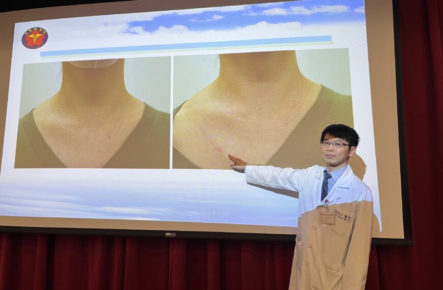 台灣新聞通訊社-脖子不留疤 甲狀腺「無頸部切口」手術減輕麻木、被勒緊的感覺