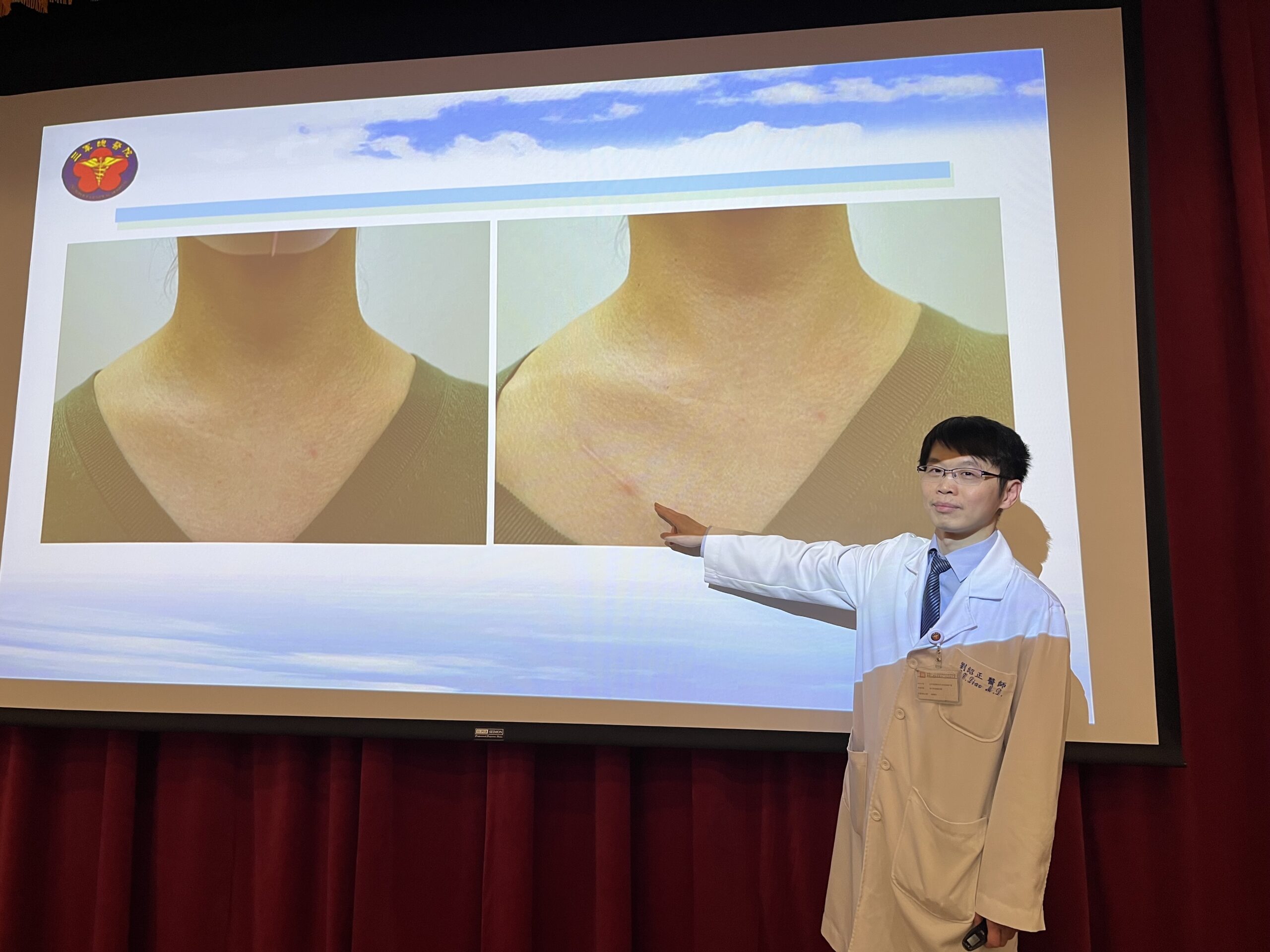 台灣新聞通訊社-脖子不留疤 甲狀腺「無頸部切口」手術減輕麻木、被勒緊的感覺