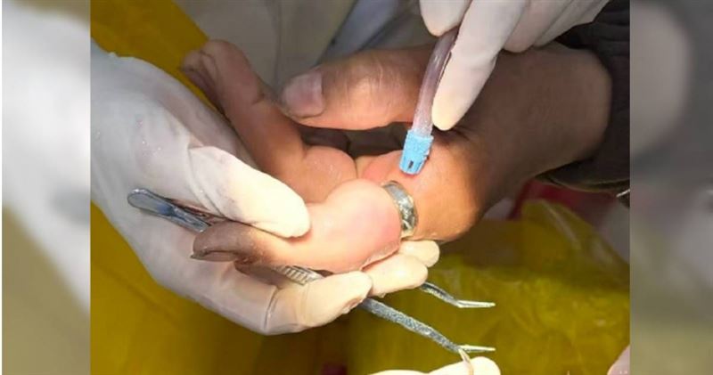 台灣新聞通訊社-戒指太緊!女子手指勒到腫脹紫爆 「這1科」醫師神救援成功