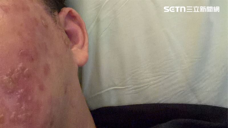 台灣新聞通訊社-30歲男患皮蛇「臉歪又耳聾」！醫曝病因：3族群要注意