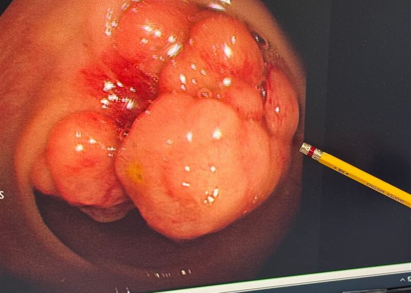台灣新聞通訊社-沒打瘦瘦針3個月狂瘦10KG！以為減肥成功卻罹大腸癌　醫嘆：腫瘤塞滿腸