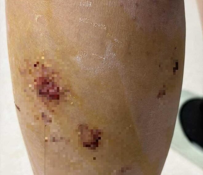 台灣新聞通訊社-女大生遭流浪狗圍咬「全身20傷」慘患瘋狗病　同學單車撞狗神救援