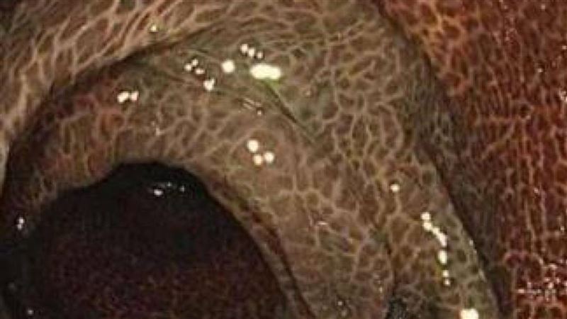 台灣新聞通訊社-喝通便茶10年！女連5天拉不出送醫　慘變「豹紋腸」切30cm保命