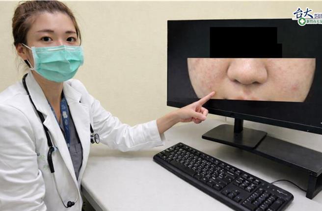 台灣新聞通訊社-10歲女童突全身紅疹 醫示警:恐是過敏性休克前兆