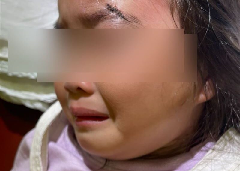 台灣新聞通訊社-獨／台中幼兒園長「愛犬」暴走　2歲女童遭撕咬破相差1公分失明、縫8針