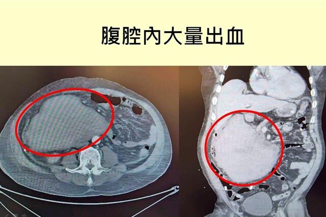 台灣新聞通訊社-歡聚變驚魂！一記推踹致十二指腸損傷 內出血險奪命