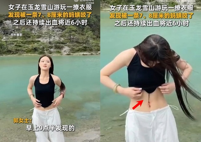 台灣新聞通訊社-正妹露腰打卡變驚魂記！ 肚臍遭水蛭偷襲「狂流血」