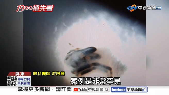 台灣新聞通訊社-高雄7旬翁揉眼紅腫 醫師掀開眼皮嚇壞驚呼前所未見：還抱400顆卵