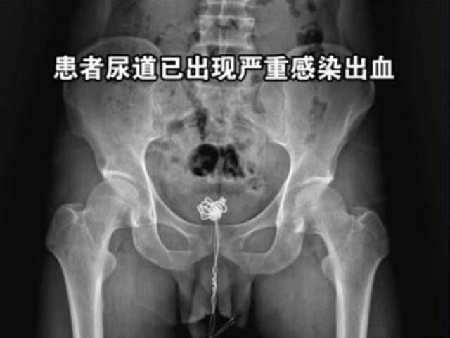 台灣新聞通訊社-好奇險殞命！男將「這東西」塞尿道 驚人X光片曝光