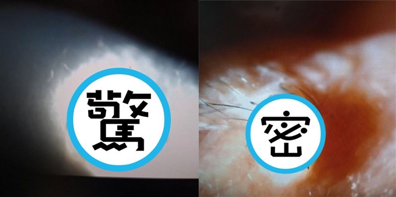 台灣新聞通訊社-屏東男午睡遭「蜘蛛爬進眼」險瞎 爪子緊鉤睫毛…醫揭驚險拆彈過程