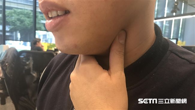 台灣新聞通訊社-50歲男不菸不酒！喉嚨卡1個月「腫瘤塞滿呼吸道」　醫驚：再大恐窒息