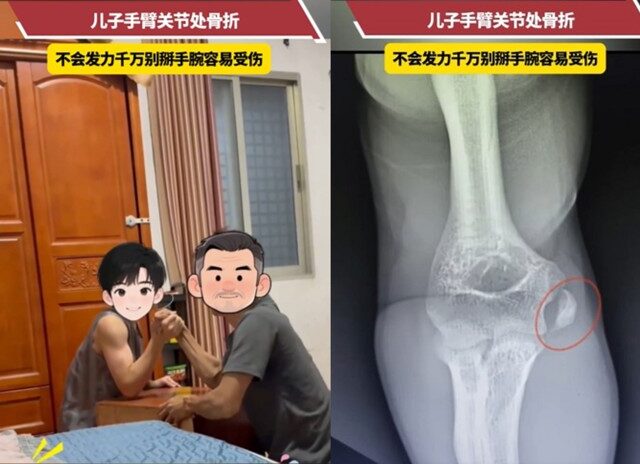 台灣新聞通訊社-父子「腕力對決」出事了！ 下一秒手肘骨折躺醫院