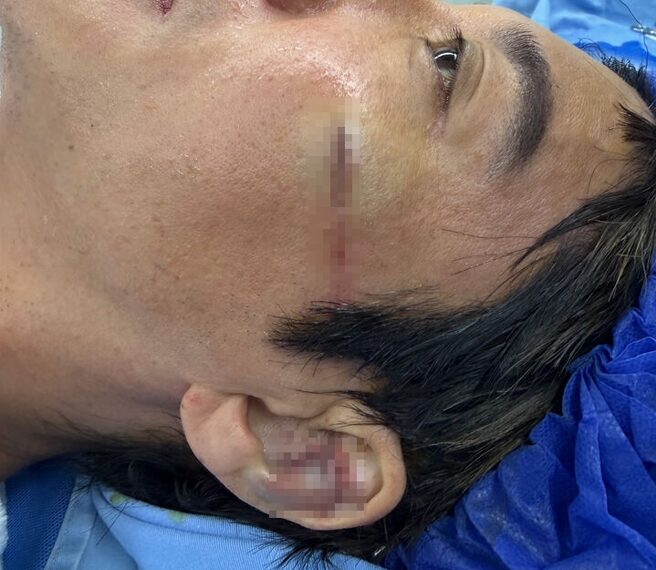 台灣新聞通訊社-快訊》王力宏開唱重摔送醫縫39針　耳骨撞碎爆血、驚悚傷勢照曝光！