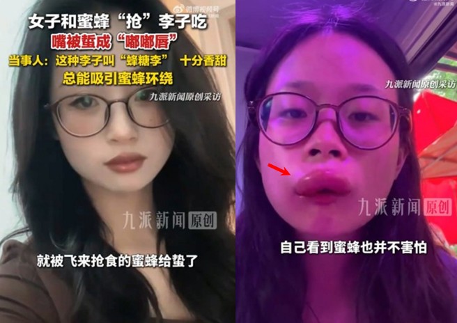 台灣新聞通訊社-豐唇不用去整形! 正妹遇蜜蜂搶食慘變「香腸嘴」