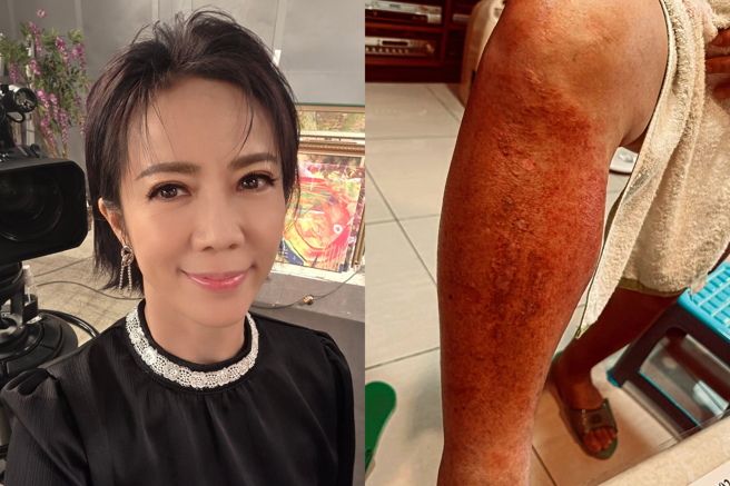 台灣新聞通訊社-陳仙梅爸爸突爆蜂窩性組織炎住院!疑血糖過高引起急壞全家