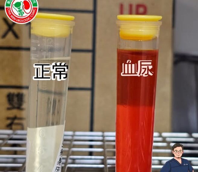 台灣新聞通訊社-他解出「一管紅色尿」怕爆 醫曝血尿5成因:不痛的最該警惕