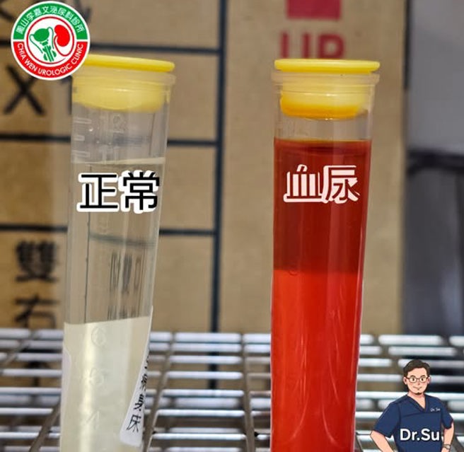 台灣新聞通訊社-他解出「一管紅色尿」怕爆 醫曝血尿5成因：不痛的最該警惕