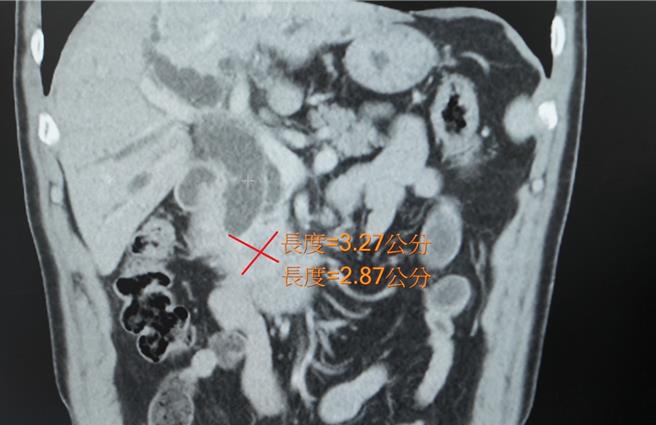 台灣新聞通訊社-胰臟癌難發現！台中男上腹痛以為胃病 一查已轉移肝臟