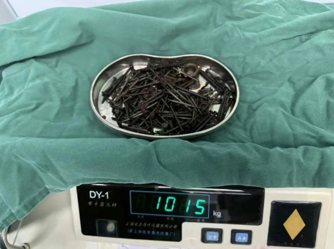 台灣新聞通訊社-異食癖竟吞下1公斤金屬物 雲南男腹裡取出181根鐵釘